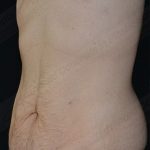 CoolSculpting Before & After Patient #1120