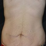 CoolSculpting Before & After Patient #1120