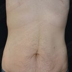 CoolSculpting Before & After Patient #1120