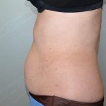 CoolSculpting Before & After Patient #1131