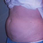 CoolSculpting Before & After Patient #1131