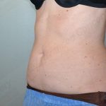 CoolSculpting Before & After Patient #1131