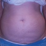 CoolSculpting Before & After Patient #1131