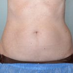 CoolSculpting Before & After Patient #1131
