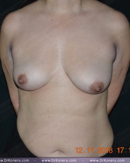 Breast Augmentation Before & After Patient #1164