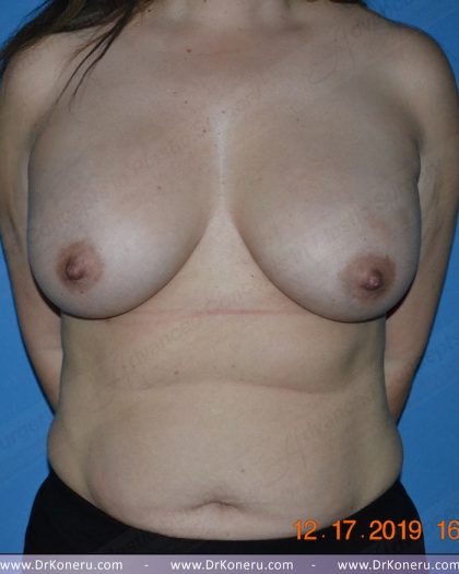 Breast Augmentation Before & After Patient #1164