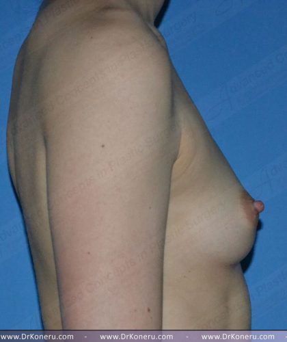 Breast Augmentation Before & After Patient #1312