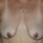 Breast Lift Before & After Patient #1336