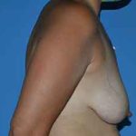 Breast Lift Before & After Patient #1336