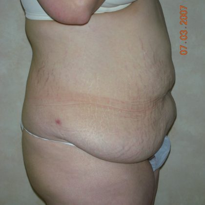 Belt Lipectomy Before & After Patient #2012