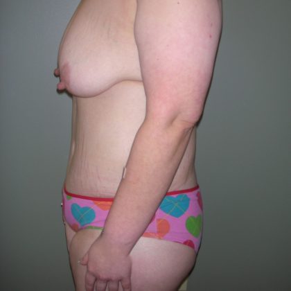 Belt Lipectomy Before & After Patient #2012