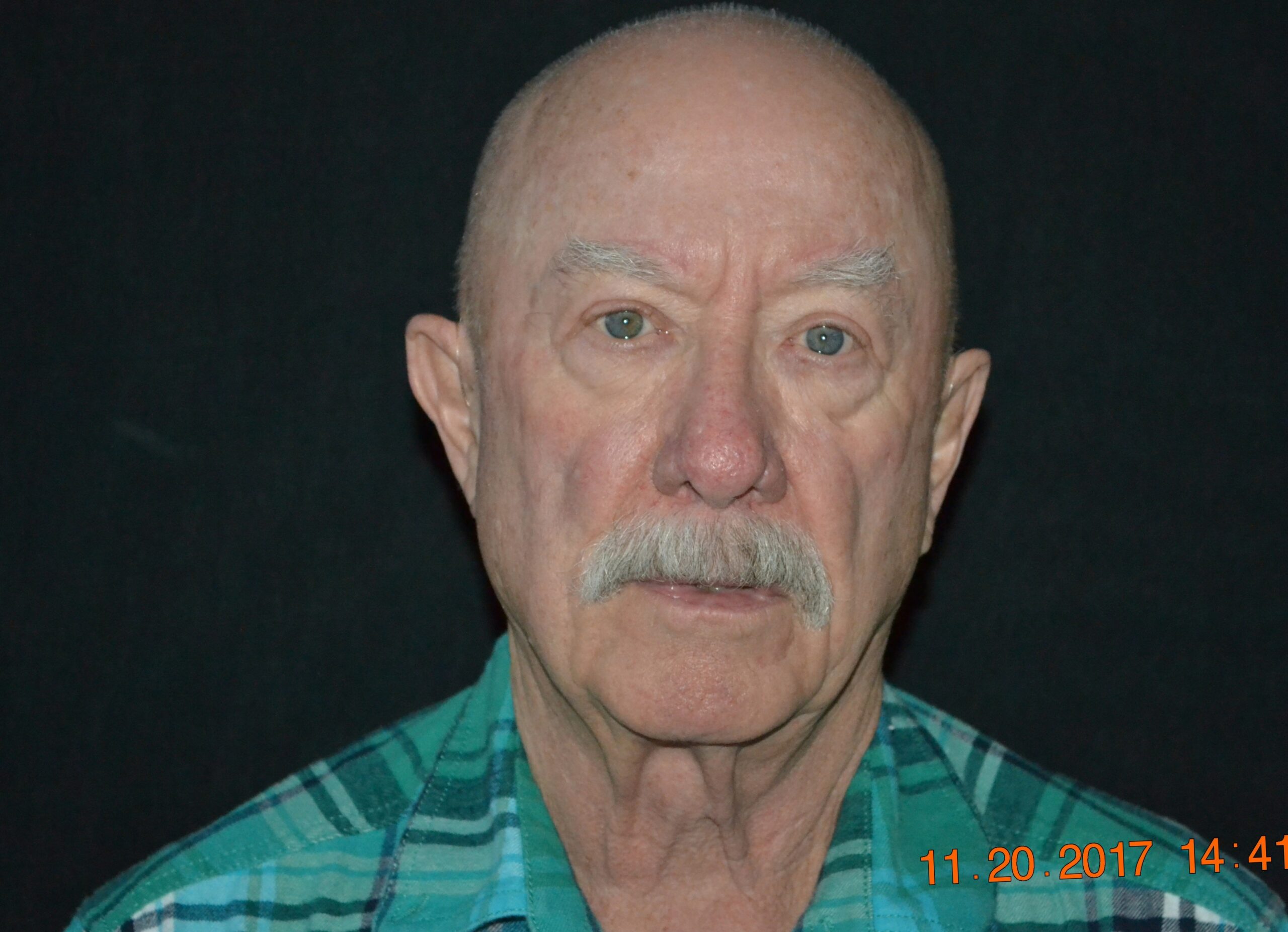 11307 1 m upper lid bleph + browlift 2017 (5)