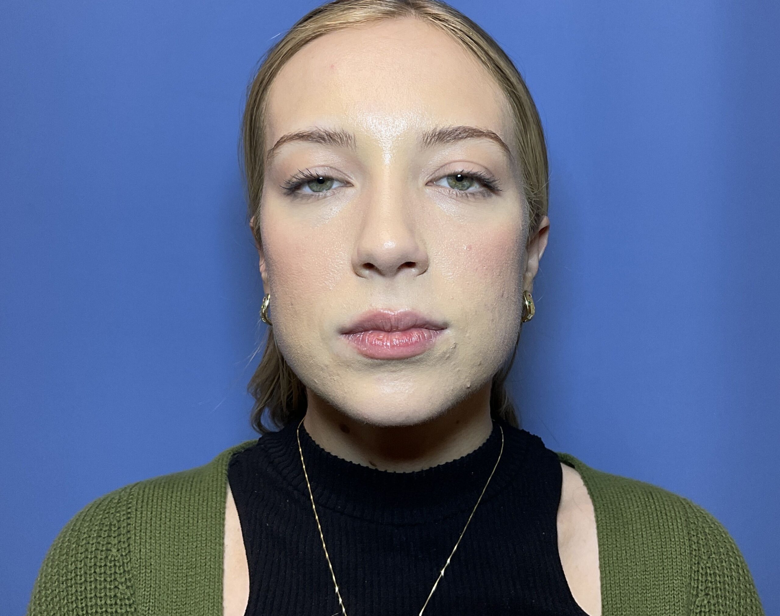 14172 2m neck lipoma 2024 (2)