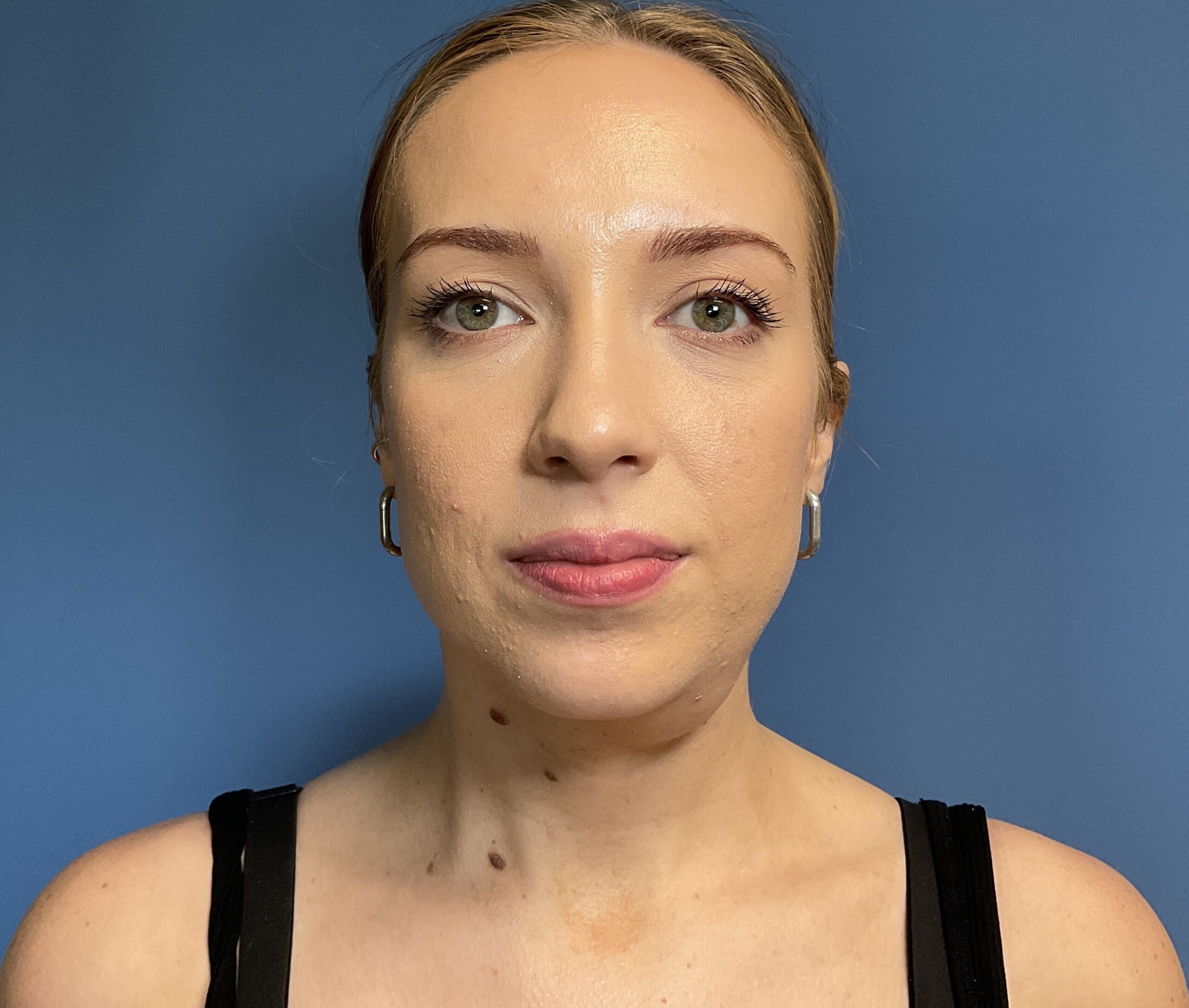 14172 preop neck lipoma 2024 (6)