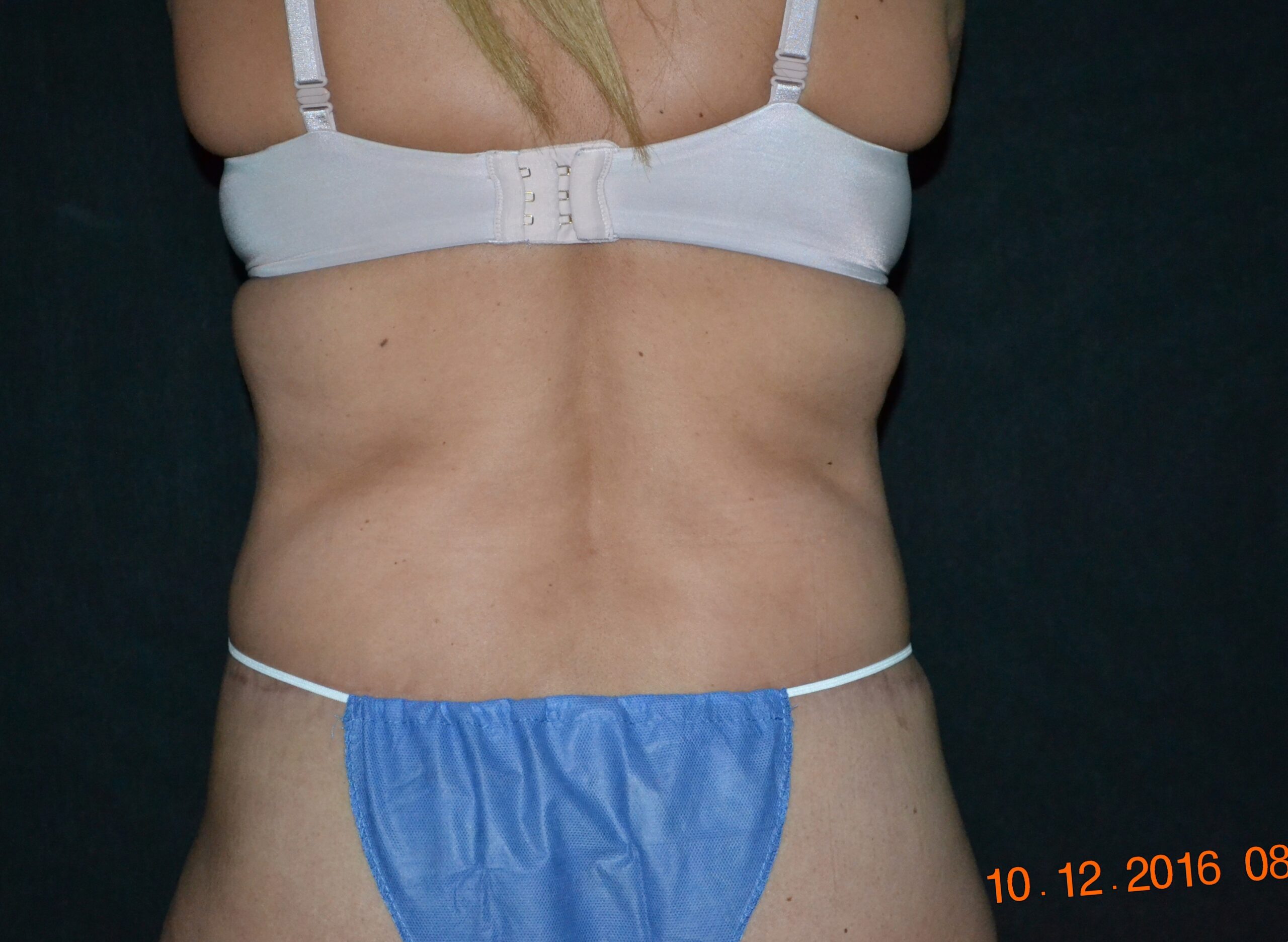 2812 7 m ftgraft to bttock 2016 (7)