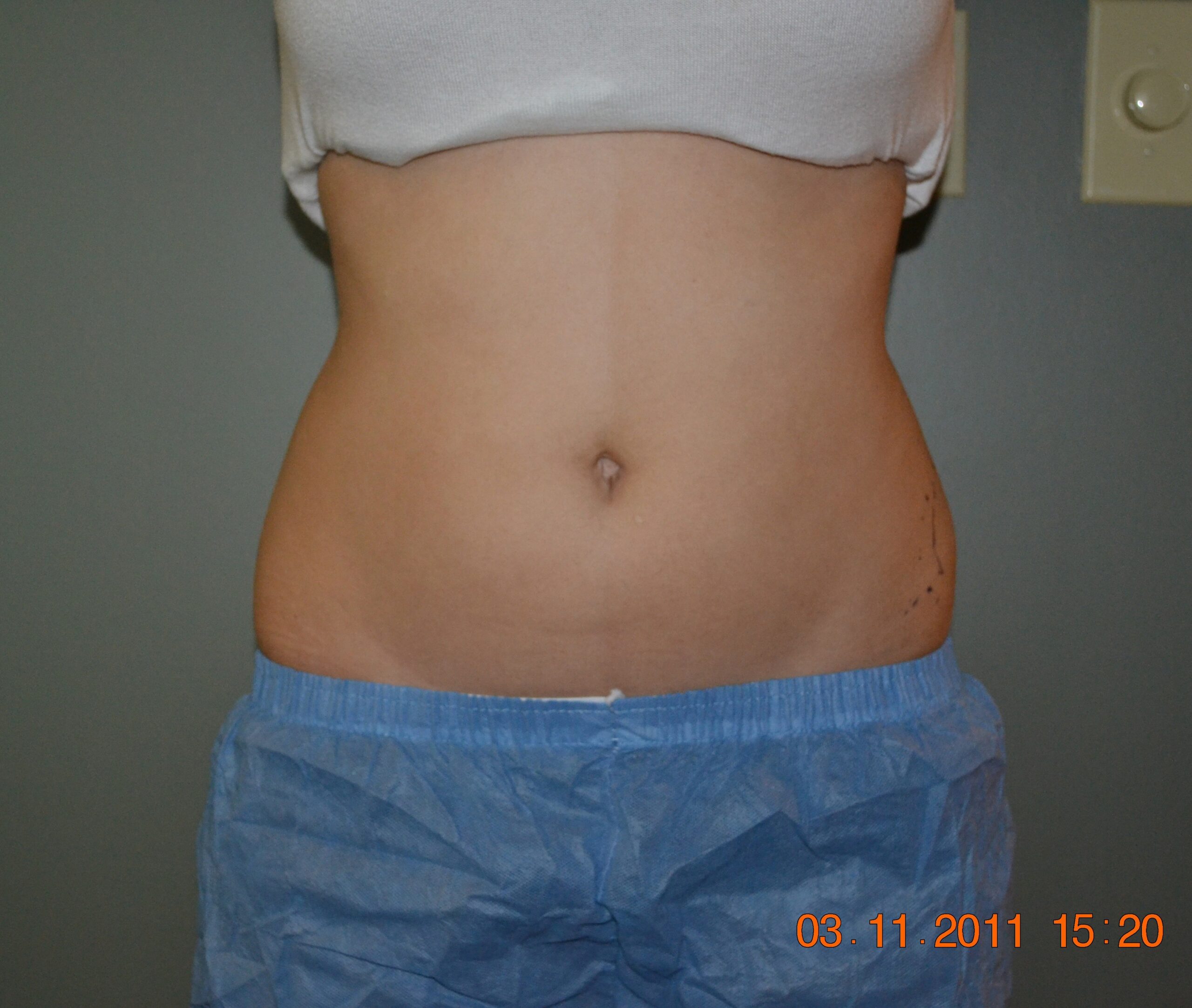 2856 9 m cool sculpting 2010 (7)