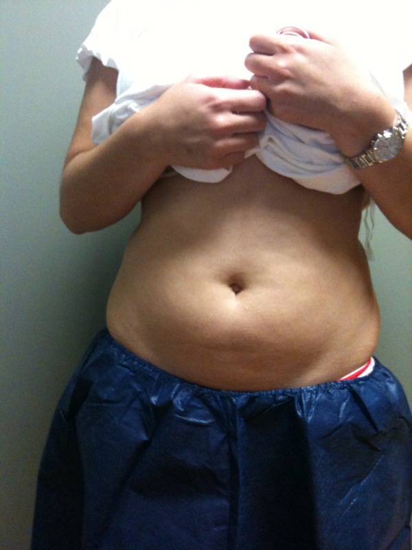 2856 pre cool sculpting 2010 (3)