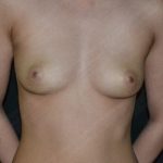 Breast Augmentation Before & After Patient #383