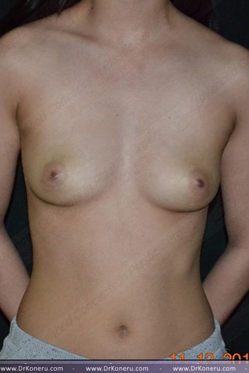 Breast Augmentation Before & After Patient #383