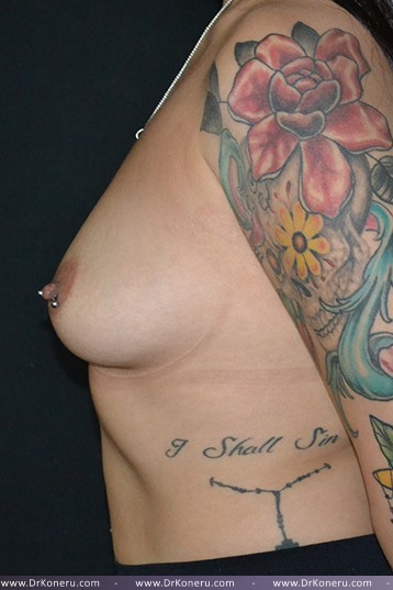 Breast Augmentation Before & After Patient #484