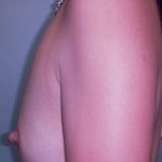 Breast Augmentation Before & After Patient #495
