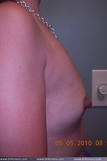 Breast Augmentation Before & After Patient #495