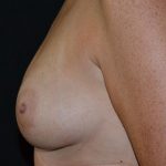 Breast Augmentation Before & After Patient #517