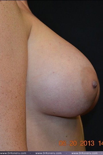 Breast Augmentation Before & After Patient #517