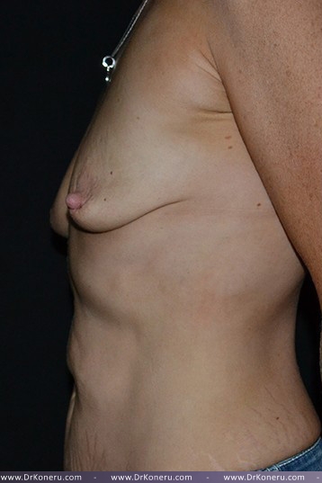 Breast Augmentation Before & After Patient #528