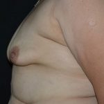 Breast Augmentation Before & After Patient #539