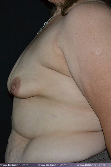 Breast Augmentation Before & After Patient #539