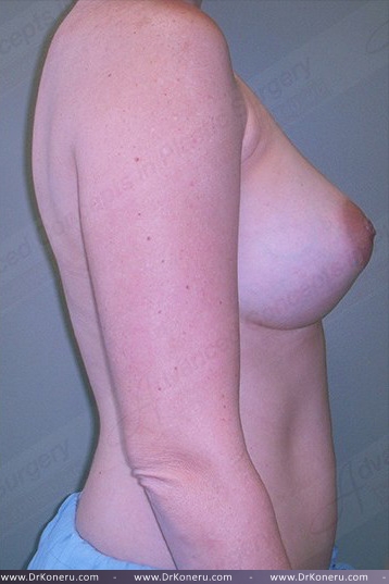 Breast Augmentation Before & After Patient #550