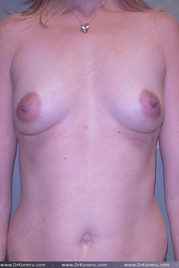 Breast Augmentation Before & After Patient #550