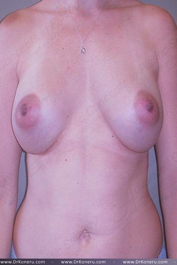 Breast Augmentation Before & After Patient #550