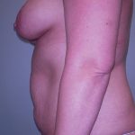 Breast Augmentation Before & After Patient #561