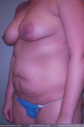 Breast Augmentation Before & After Patient #561