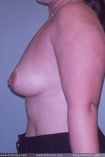 Breast Augmentation Before & After Patient #572