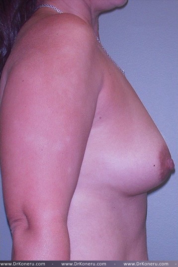 Breast Augmentation Before & After Patient #572