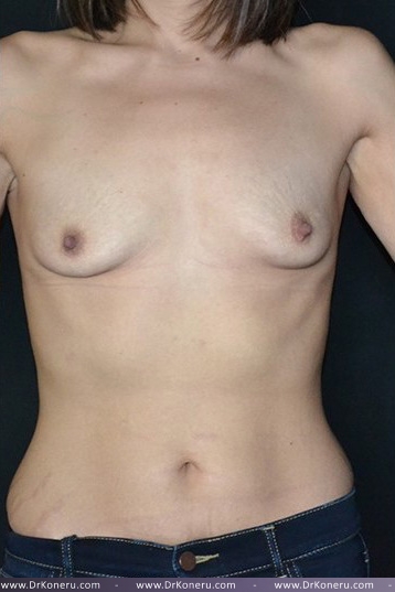 Breast Augmentation Before & After Patient #394