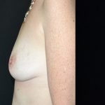 Breast Augmentation Before & After Patient #405