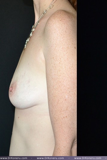 Breast Augmentation Before & After Patient #405