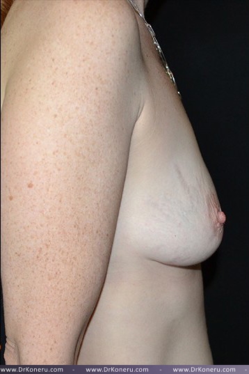 Breast Augmentation Before & After Patient #405