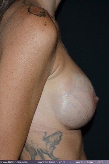 Breast Augmentation Before & After Patient #417