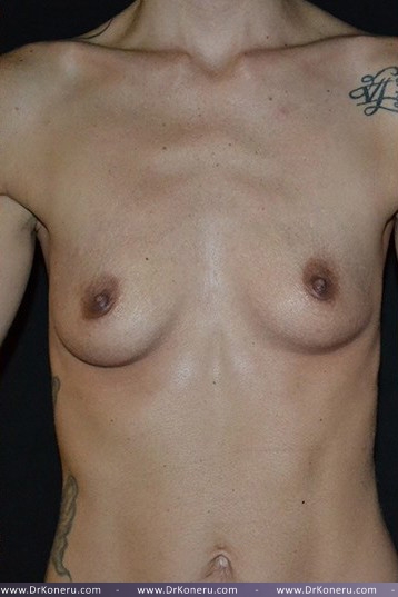Breast Augmentation Before & After Patient #417