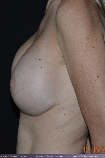 Breast Augmentation Before & After Patient #429