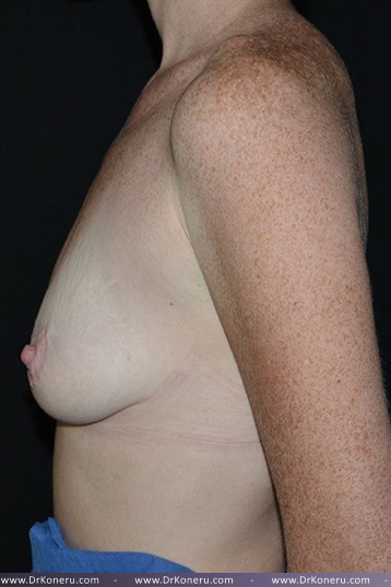 Breast Augmentation Before & After Patient #451