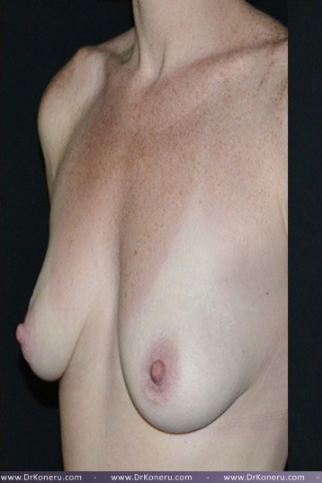 Breast Augmentation Before & After Patient #451
