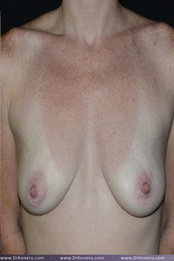 Breast Augmentation Before & After Patient #451