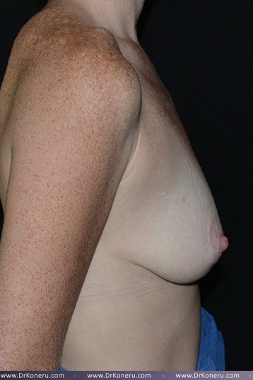 Breast Augmentation Before & After Patient #451