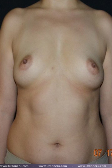 Breast Augmentation Before & After Patient #462